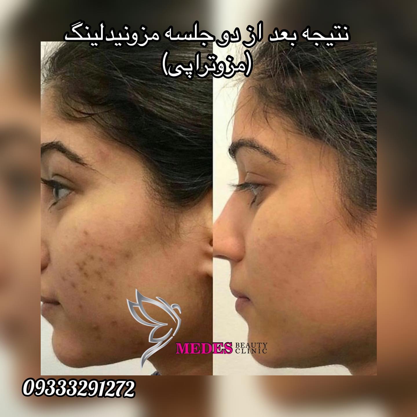 گالری مزونیدلینگ